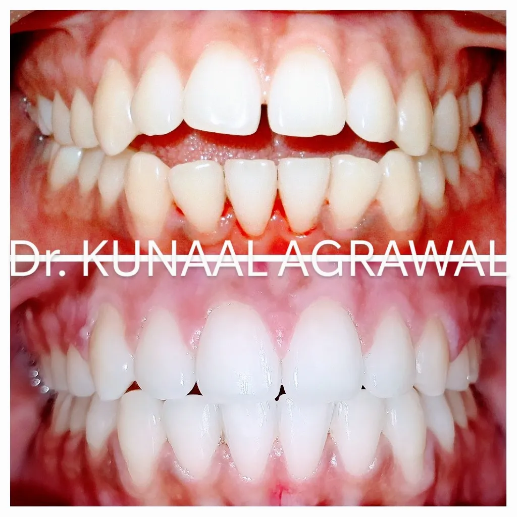 braces before and after bhopal 13